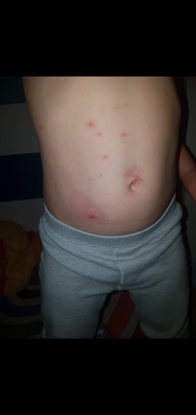 To ask how to help my DS survive chicken pox