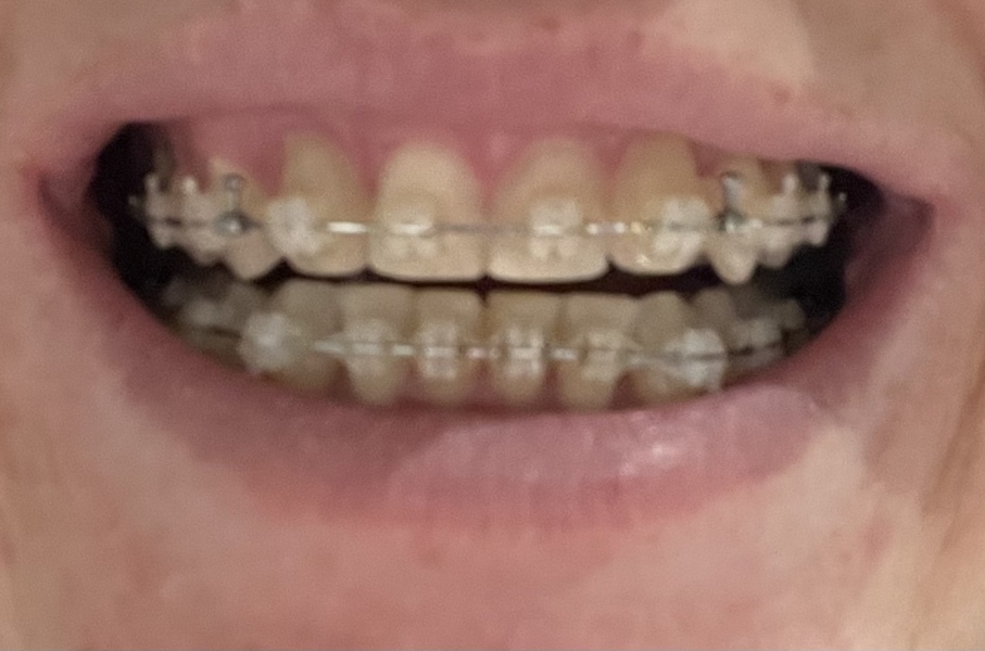 Adult Braces