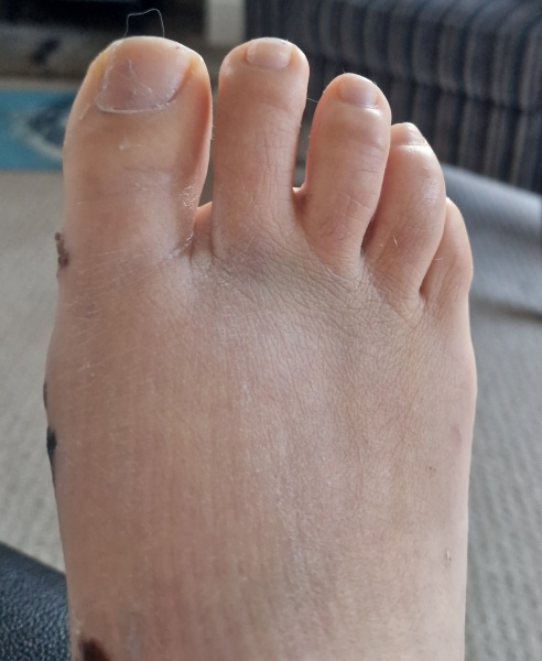 Show me a pic of your bunions…