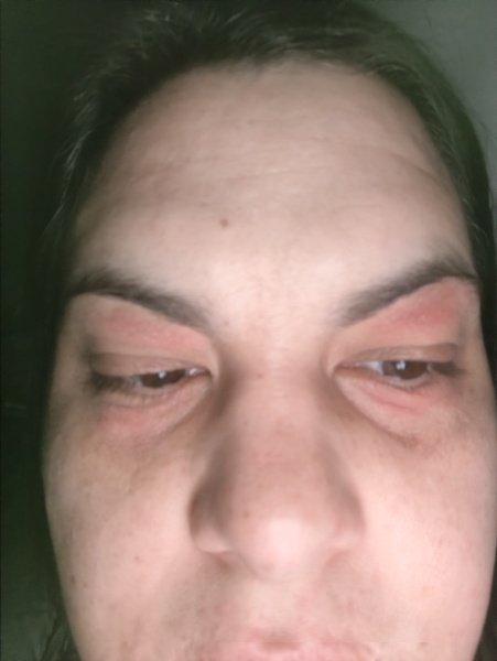 Bastarding dry sore skin on eyelids - how to sooth and calm?