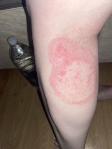 Rash in pregnancy