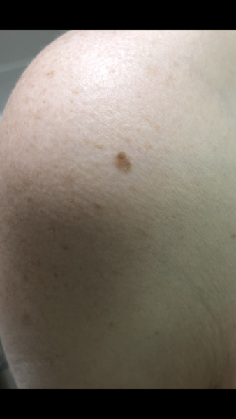 DD mole on leg - asymmetrical and two colours