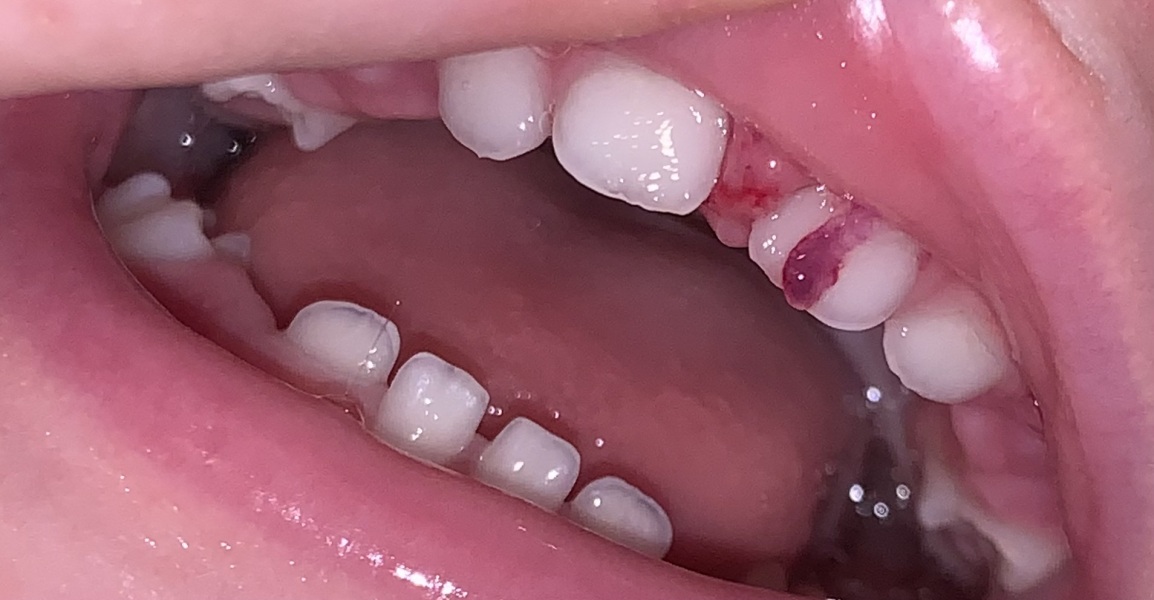 Toddlers fell and some tissue from gum loose