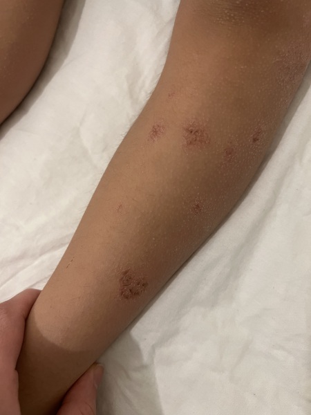 Anyone seen this type of rash before? Pic (Plus recurrent temperature)