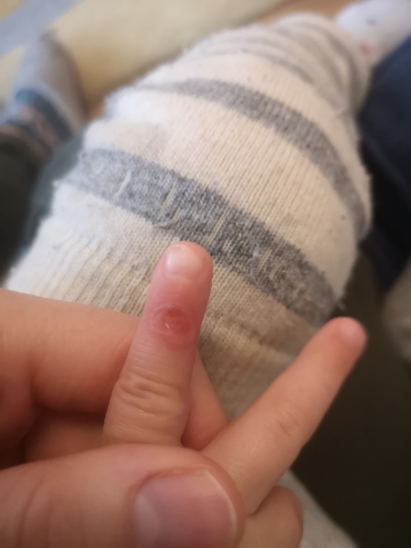 Chicken pox - does this look infected?