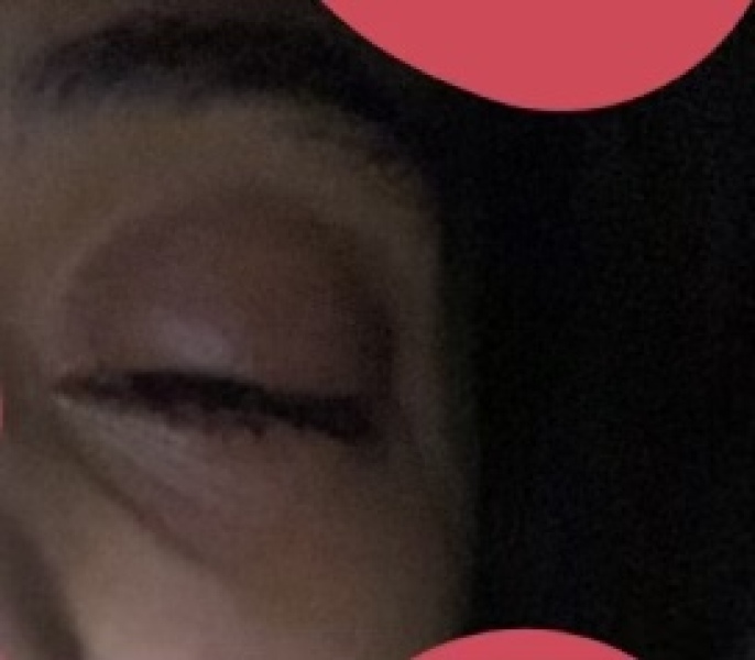 Daughter - Eye infection 