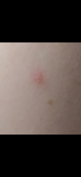 Any dermatologists around? 