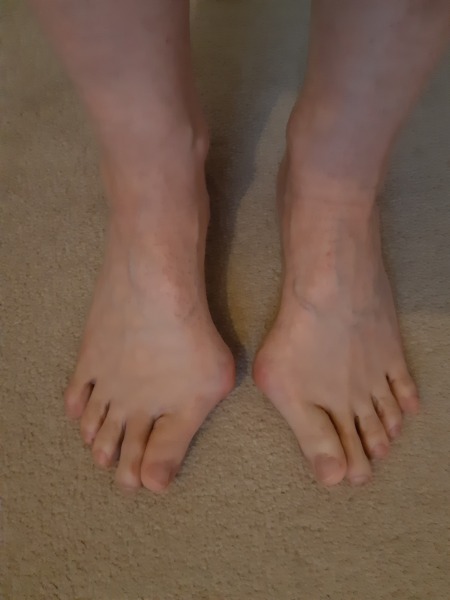 Show me a pic of your bunions…