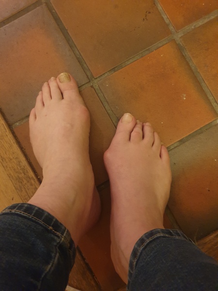 Show me a pic of your bunions…
