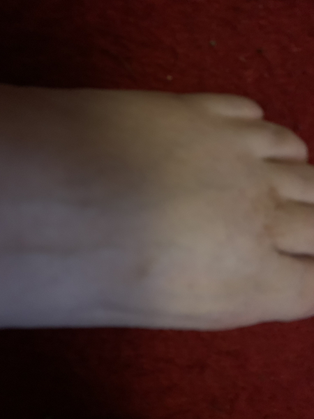 Show me a pic of your bunions…