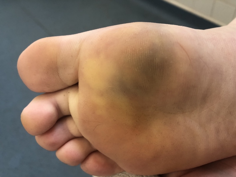 Bizarre and spontaneous foot injury