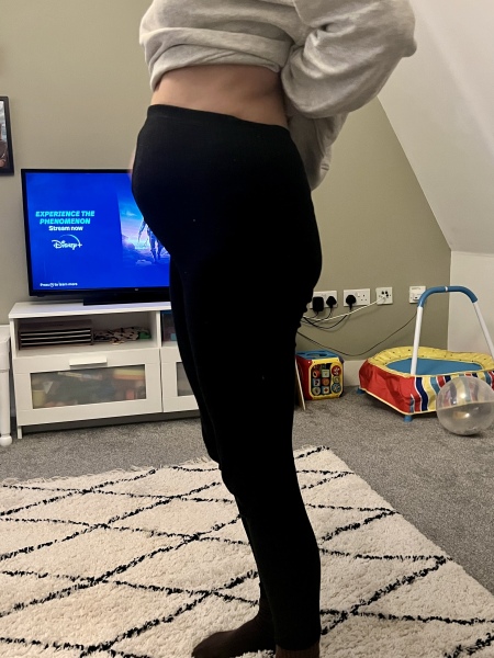 I have a spearated abdomen, also called 'Diastasis Recti'