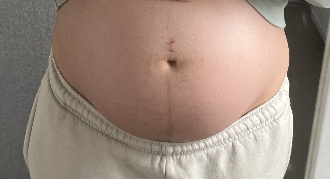 Discolouration on stomach