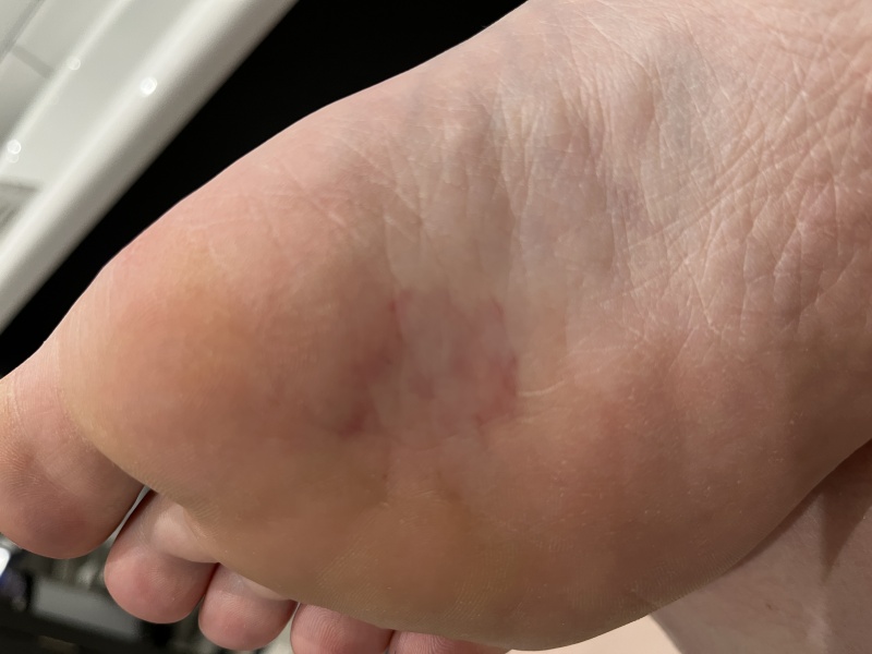 PICTURE: Scary broken red veins under foot 