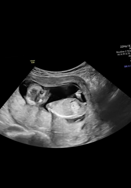 Boy or girl? Nub theroy 13+1