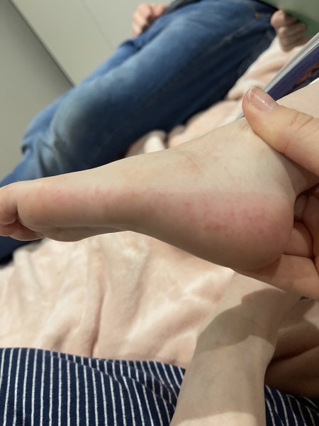 Anyone know what this rash is?