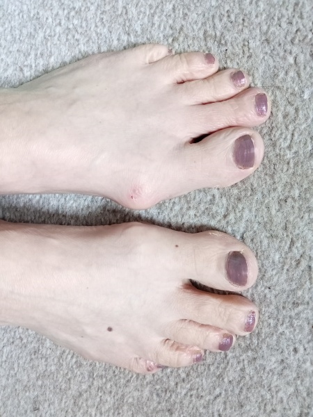 Show me a pic of your bunions…