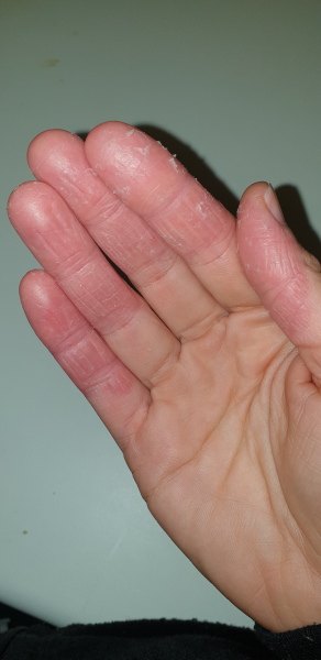 Is this hand Psoriasis?