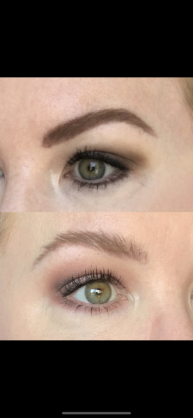 Eye lash growth serums can cause orbital fat loss