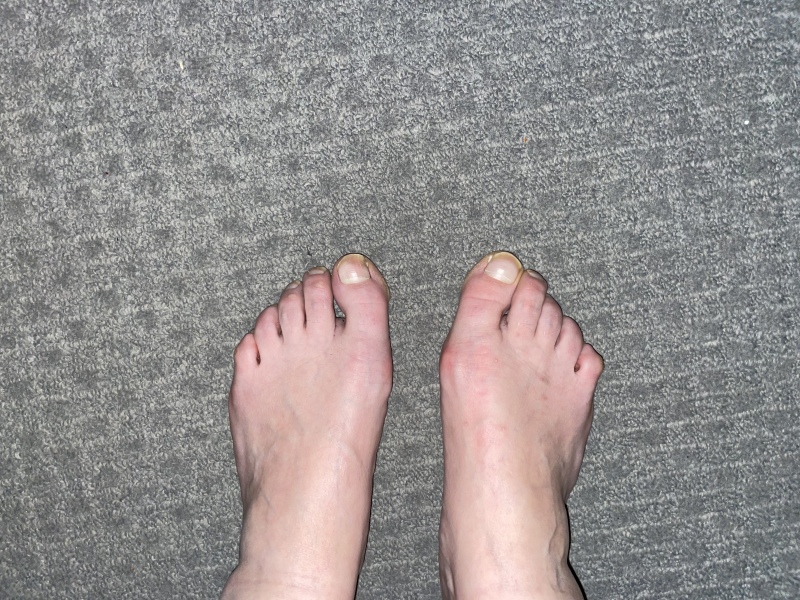 Show me a pic of your bunions…