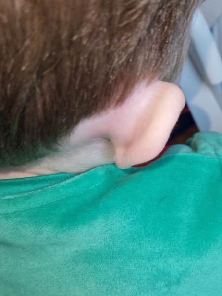 Is this mastoiditis?