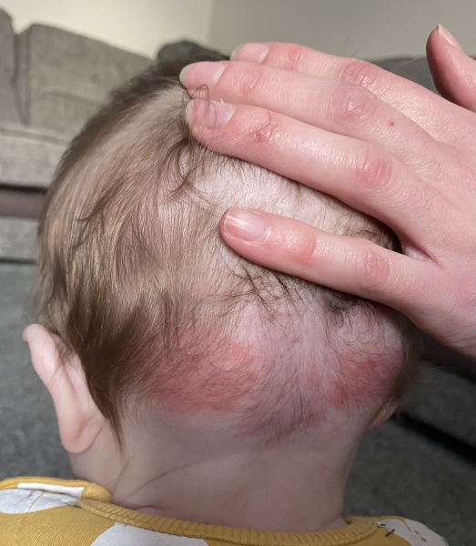 Reappearing and disappearing red patches