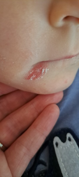 What is this? Eczema or impetigo