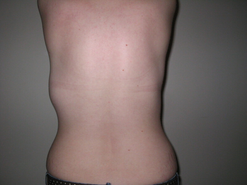 Lipoma on back