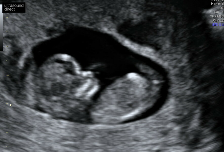 What sex is my baby? Nub Theory 