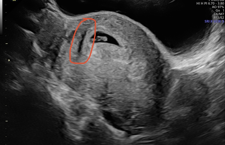 Early scan/second sack?