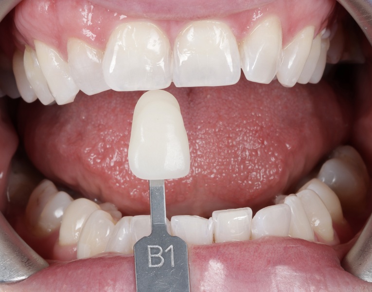 Invisalign question (with photo )