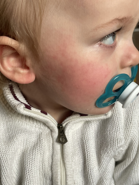 Allergy to penicillin?