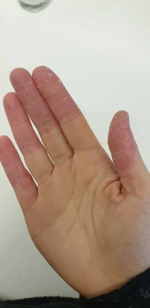 Is this hand Psoriasis?