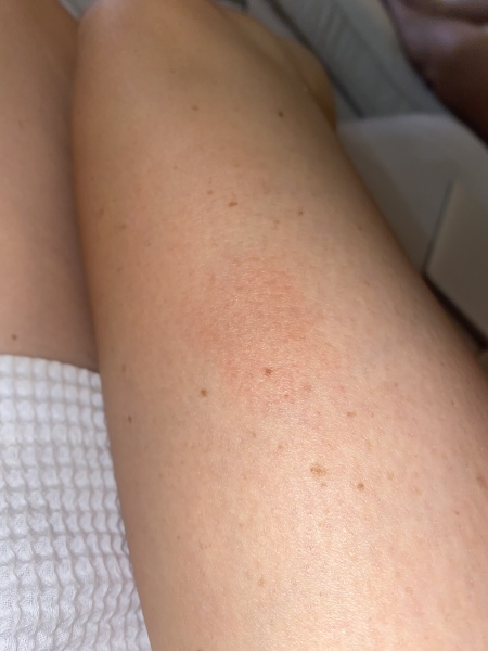 What is this weird rash/mark? 