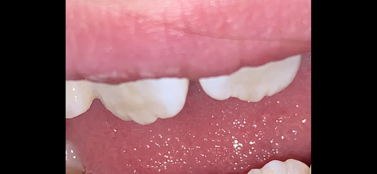 Discoloured teeth - 8 year old 