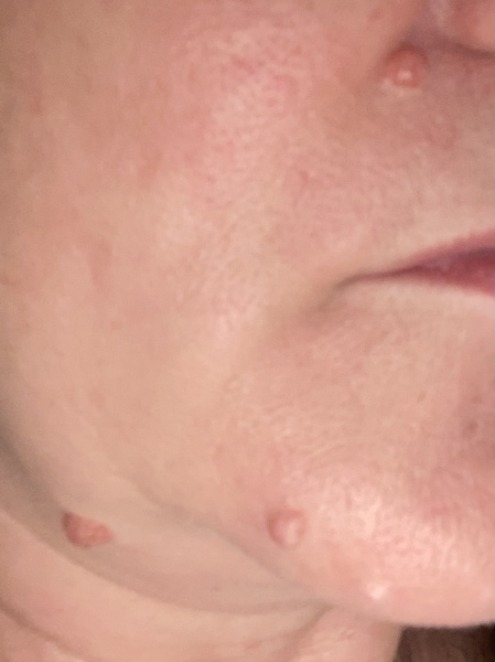 Mole removal 