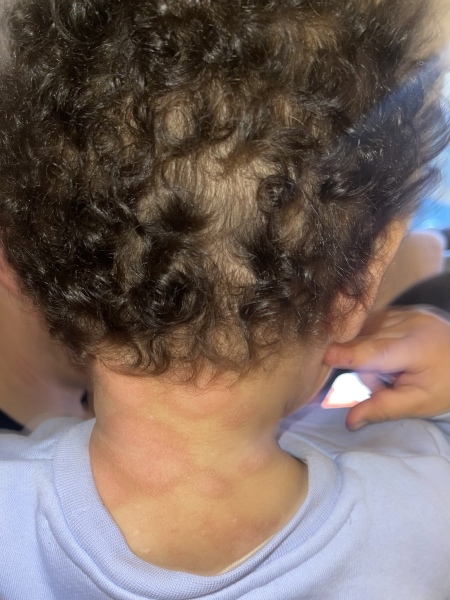 Could this be ringworm? 