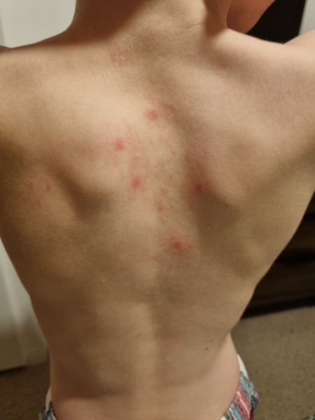 What does chicken pox look like in vaccinated kids?