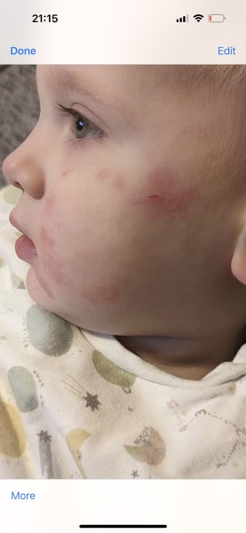 Does ds need to see a doctor re rash reappearing constantly
