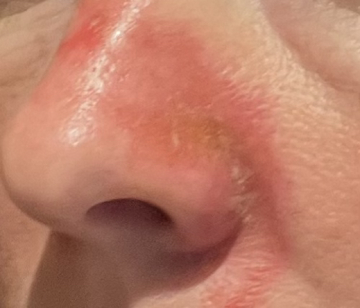 fluorouracil cream for pre cancerous skin