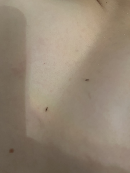 Photo of lice, what age/stage would you say these are ? 