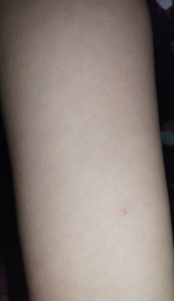Chickenpox? Pics?