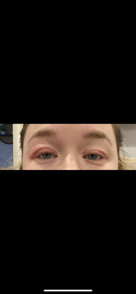 Bastarding dry sore skin on eyelids - how to sooth and calm?