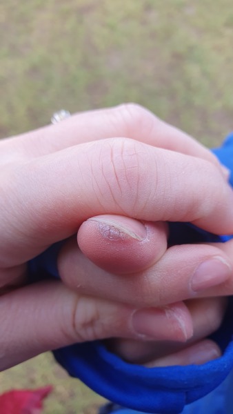 Is this a burn or fungus?