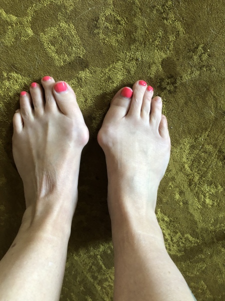 Show me a pic of your bunions…