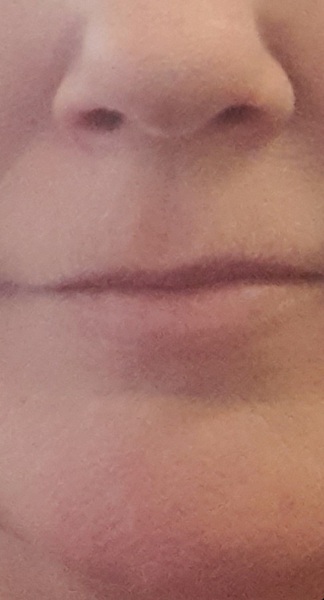 To get lip filler at aged 50