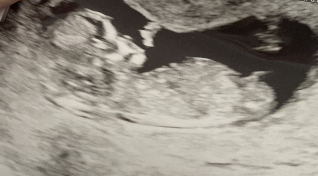 Ultrasound: Is This A Boy Or Girl?