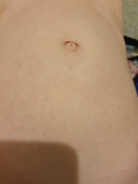 Rash all over