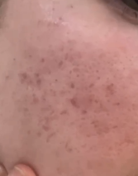 To be at my wits end about my skin!!