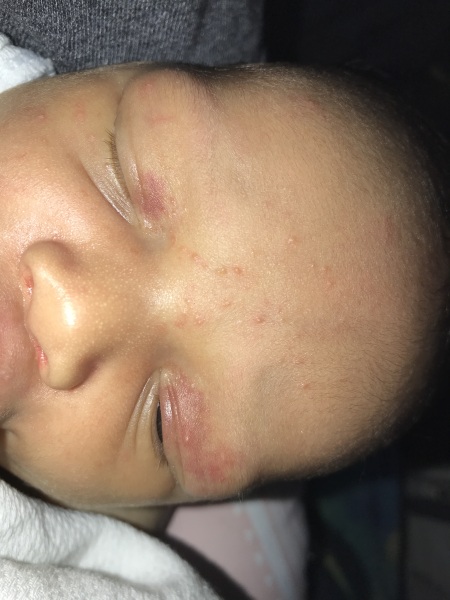 Baby face rash/spots?!